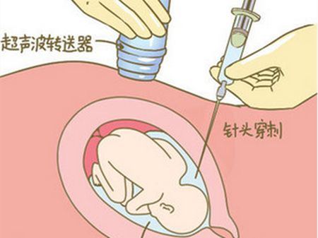 孕期檢查 產(chǎn)檢 唐氏兒