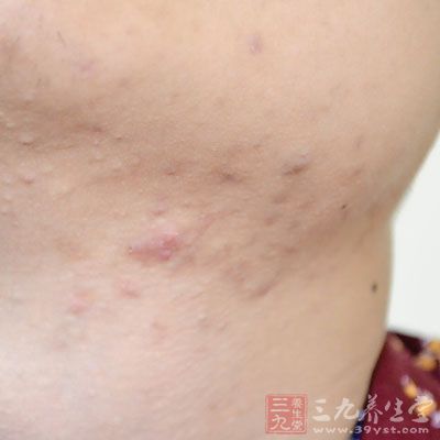 驚 這些病經(jīng)常被誤診為感冒 麻疹早期的情況和感冒也十分的相似