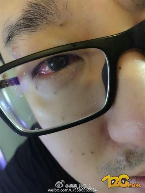 LOL笑笑孫亞龍患眼疾 網(wǎng)友:失去之后才會珍惜 LOL笑笑孫亞龍患眼疾 網(wǎng)友:別等失去之后才會珍惜